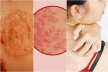 Treating Bullous Pemphigoid Naturally: The Top Supplements to Try - Herbal Care Products
