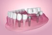 7 Factors That Determine If Dental Implants Right For You