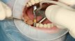 What You Need to Know About Dental Implants: The Process and Outcomes of the Treatment