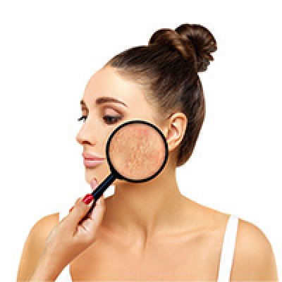 Acne Scar Removal Treatment Cost In Chennai | Laser, MNRF & Peels | Results And Reviews